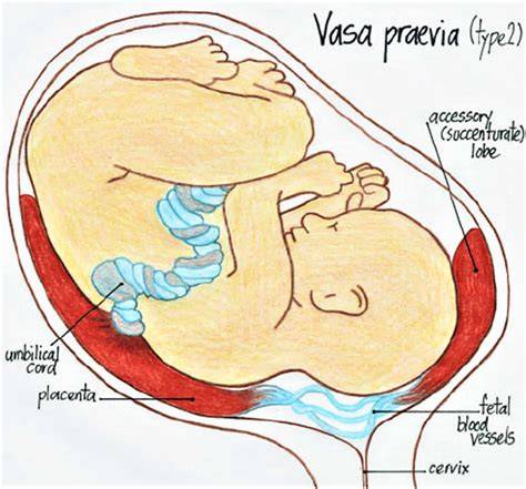 Representación esquemática de la vasa previa donde los vasos desprotegidos cruzan el orificio cervical interno