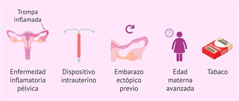 Infografía sobre los factores de riesgo de un embarazo ectópico