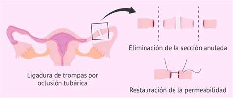 Esquema de las trompas de Falopio antes y después de la ligadura