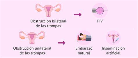 Ilustración de cómo se bloquean las trompas de Falopio con Essure