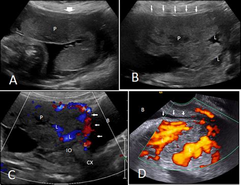 Imágenes ecográficas de placenta accreta con lagunas placentarias y adelgazamiento miometrial