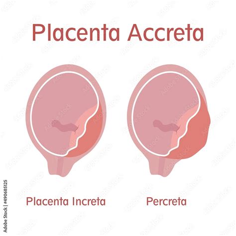 Infografía: Hallazgos ecográficos clave en placenta accreta, increta y percreta
