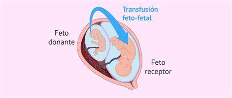 Infografía sobre el Síndrome de Transfusión Feto-Fetal y su tratamiento
