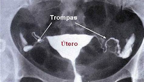 Radiografía de histerosalpingografía mostrando las trompas de Falopio
