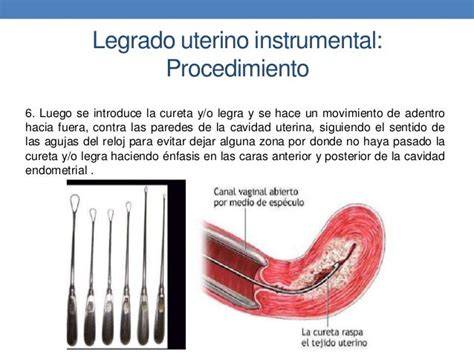 Esquema del útero y los instrumentos utilizados en un legrado por raspado