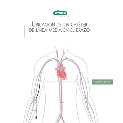 Imagen de un catéter de línea media insertado en el brazo de un niño