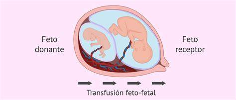 Diagrama explicando el síndrome de transfusión feto-fetal en una placenta monocorial con anastomosis vasculares.