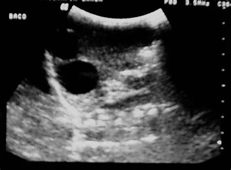 Ecografía abdominal: dos formaciones quísticas en el bazo, con 24 y 19 mm de diámetro