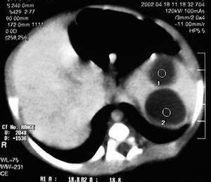 TC abdominal: lesiones nodulares intraesplénicas de 23 y 27 mm