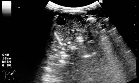 Ecografía abdominal: quiste esplénico con 12 mm de diámetro