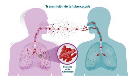 Esquema sobre la transmisión de tuberculosis de madre a hijo
