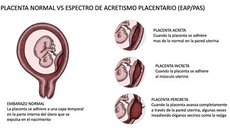 Esquema anatómico que muestra los grados de invasión miometrial: placenta acreta (adherida), increta (invade el miometrio) y percreta (atraviesa la serosa).