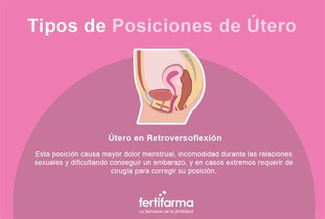 Esquema comparativo de útero en anteversión y útero en retroversión (grados 1, 2, 3)