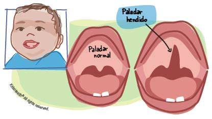 Esquema anatómico que muestra la diferencia entre un paladar normal y un paladar hendido, ilustrando la falta de fusión de los tejidos.