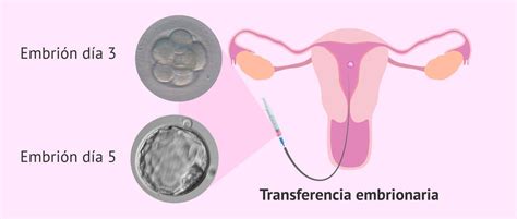 Esquema del procedimiento de transferencia embrionaria mostrando la introducción del catéter en el útero.