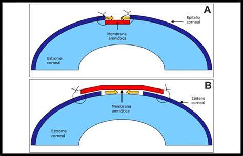 Microfotografía o diagrama del uso de injertos de membrana amniótica en medicina regenerativa ocular.