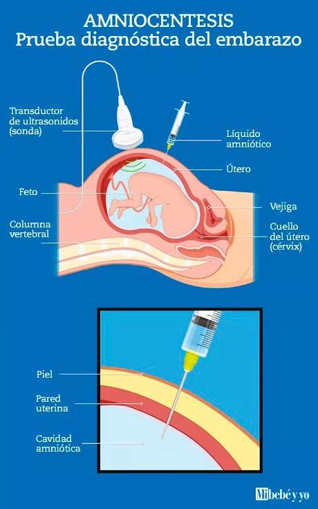Infografía explicativa sobre la amniocentesis y sus aplicaciones en el segundo trimestre