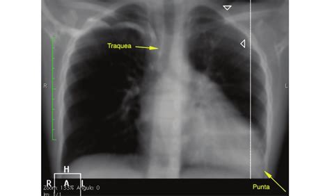 Radiografía de tórax mostrando la barra correctora para pectus excavatum