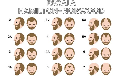 Gráfico comparativo de los patrones de caída en hombres (Escala Hamilton-Norwood) y mujeres (Escala Ludwig)