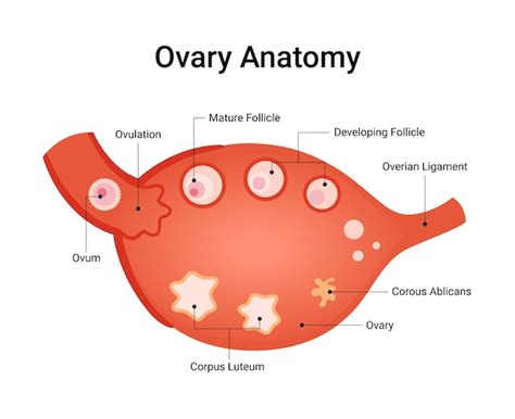 Esquema anatómico que muestra la ubicación de los ovarios y la formación de un quiste folicular versus un ovario sano.