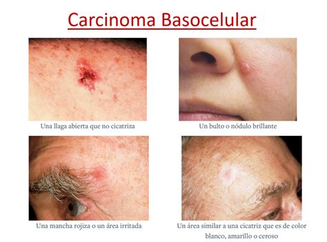 Esquema explicativo de un carcinoma basocelular en la piel