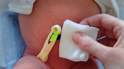 Fotografía detallada de un cordón umbilical con la pinza