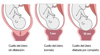Esquema del progreso de la dilatación del cuello uterino durante el parto