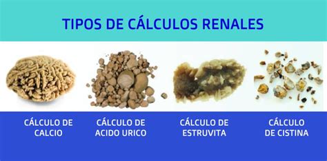 Diagrama de cálculos renales en el sistema urinario