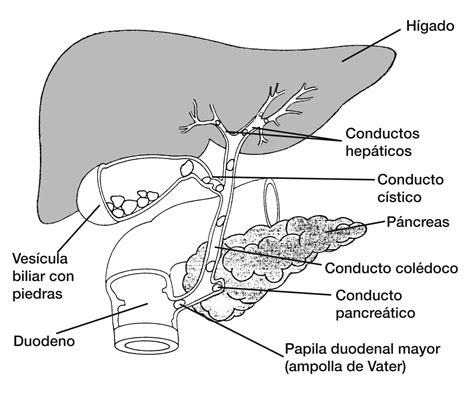 Esquema de la vesícula biliar con cálculos biliares