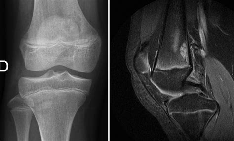 Radiografía AP y RM T2 sagital con supresión grasa mostrando irregularidad cortical femoral distal. Lesión radiolúcida, bien definida, con márgenes escleróticos, de base cortical, en la metáfisis femoral posteromedial distal.