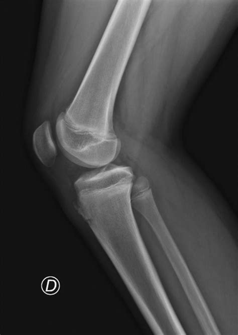 Proyección lateral de radiografía mostrando irregularidad de la tuberosidad anterior de la tibia con aumento de grosor del tendón rotuliano, característico de la enfermedad de Osgood-Schlatter.