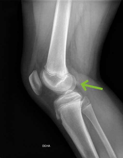 Radiografía lateral mostrando fragmentación del polo inferior de la rótula, indicativa de la enfermedad de Sinding-Larsen-Johansson.