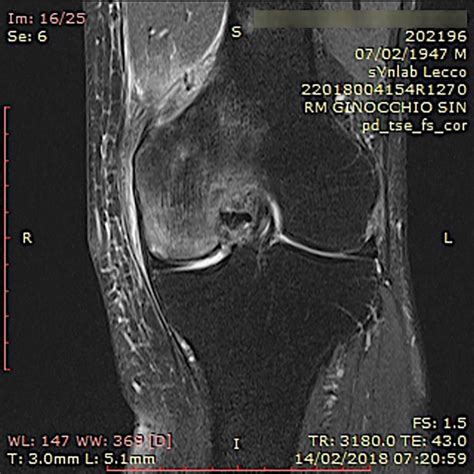 RM T2 coronal mostrando un defecto subcondral en el cóndilo femoral medial, característico de osteocondritis disecante.