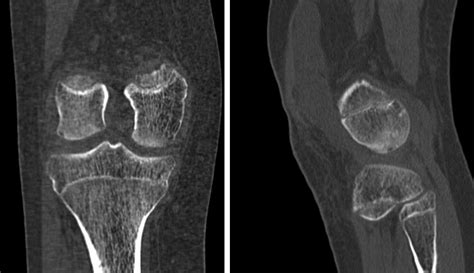 TC coronal y sagital en ventana ósea mostrando osificación irregular en la porción posterolateral del cóndilo femoral lateral como variante normal.