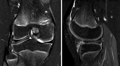 RM T2 coronal y sagital con supresión grasa de un menisco lateral discoideo con alteración de señal horizontal compatible con rotura.