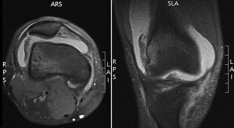 RM secuencia DP FAT SAT axial y coronal mostrando focos de edema en el margen medial de la rótula, porción lateral del cóndilo femoral lateral y un área de depresión en la superficie lateral del cóndilo femoral lateral compatible con fractura secundaria a episodios de luxación lateral rotuliana reducida.
