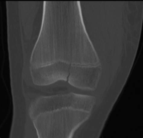 TC coronal en ventana ósea de una fractura Salter-Harris III. Rasgo de fractura en relación con el surco intercondíleo, de curso ligeramente oblicuo, que se extiende hacia la región fisaria, sin desplazamiento significativo.