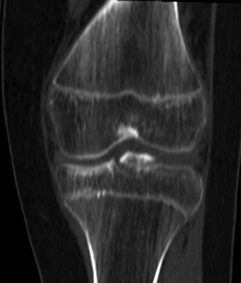 TC coronal en ventana ósea de una fractura avulsiva de la espina tibial. Rasgo de fractura que compromete la espina tibial.
