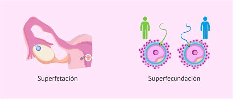Esquema comparativo entre embarazo gemelar estándar y superfetación (diferencia de desarrollo embrionario)