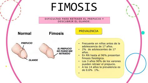 Esquema anatómico mostrando la diferencia entre un prepucio normal y una fimosis con estrechez del anillo prepucial
