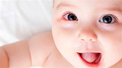 Bebé con ojos irritados y enrojecidos