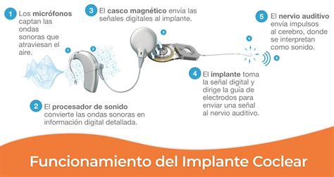 Diagrama de cómo funcionan los implantes cocleares
