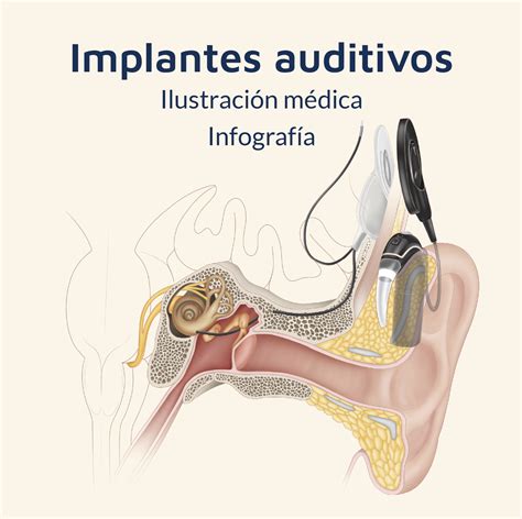 Comparativa de diferentes tipos de implantes auditivos