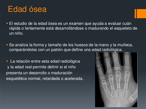 Radiografía de la mano para determinar la edad ósea en niños