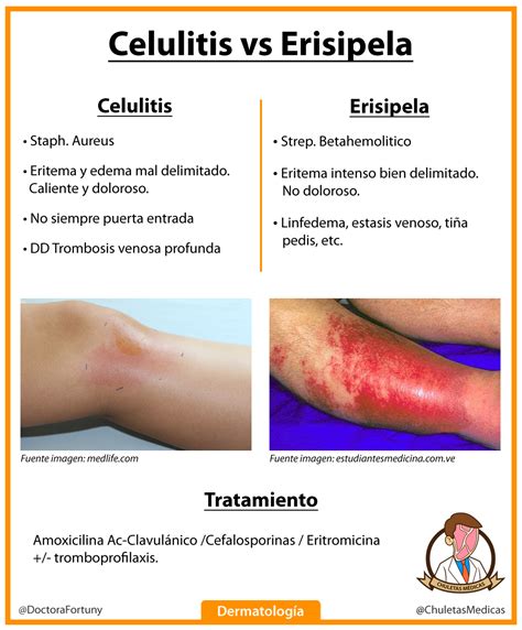 Comparación visual de lesiones de erisipela y celulitis.