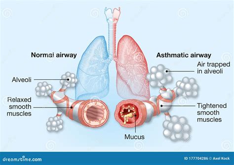 Diagrama de vías respiratorias normales y asmáticas