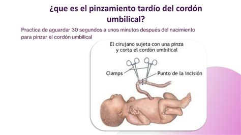 Ilustración mostrando el pinzamiento precoz y tardío del cordón umbilical
