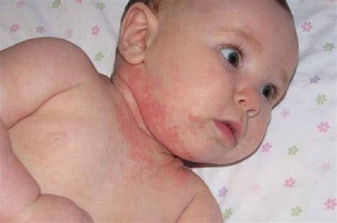 Bebé con piel enrojecida por dermatitis atópica
