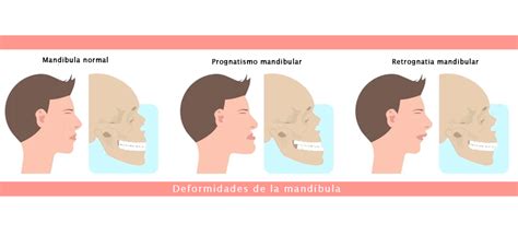 Perfil facial de un paciente con retrognatia mandibular, mostrando la mandíbula inferior retraída en comparación con el maxilar superior.