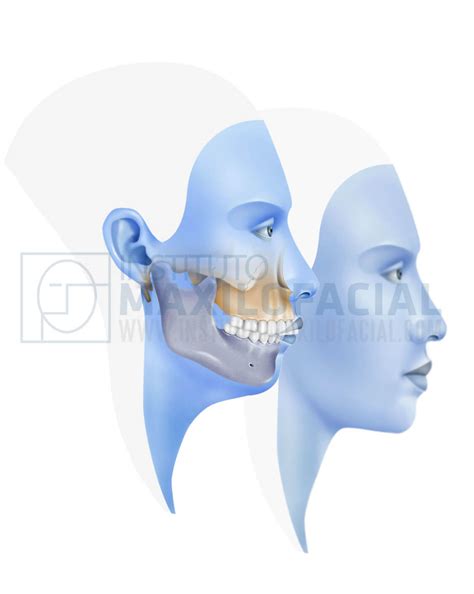 Radiografía preoperatoria y postoperatoria de una cirugía ortognática para corregir la retrognatia mandibular.